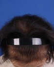 Before Hair Transplant&nbsp;Hair Thinning